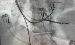 Elazığ'da Bir İlk: Fethi Sekin Şehir Hastanesi’nde Sol Dal Pacing ile Kalp Pili Ameliyatı